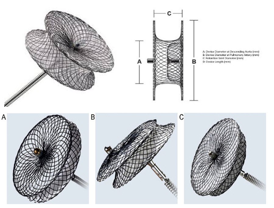 ASD, VSD, PDA Device closure Congenital Heart Desk Foundation Bangladesh