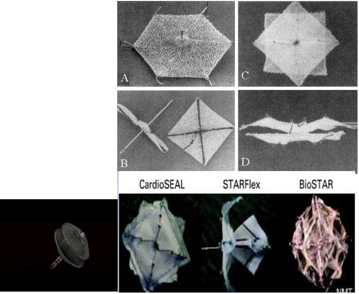 ASD, VSD, PDA Device closure Congenital Heart Desk Foundation Bangladesh