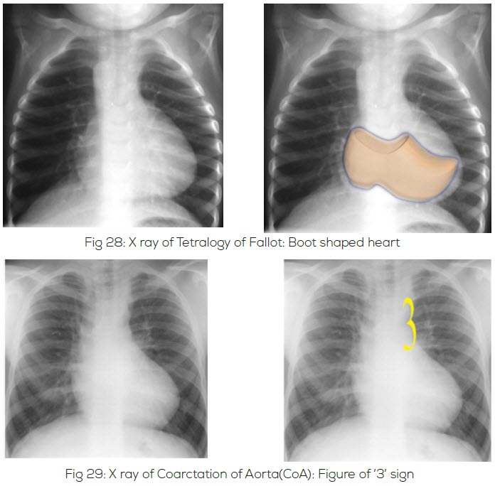 Chest Xray Congenital Heart Desk Foundation Bangladesh